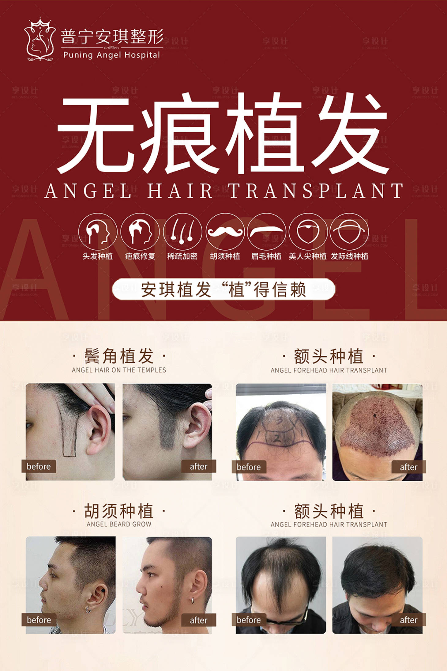 源文件下载【享设计】搜索编号：71390002725904431【无痕植发医美海报】