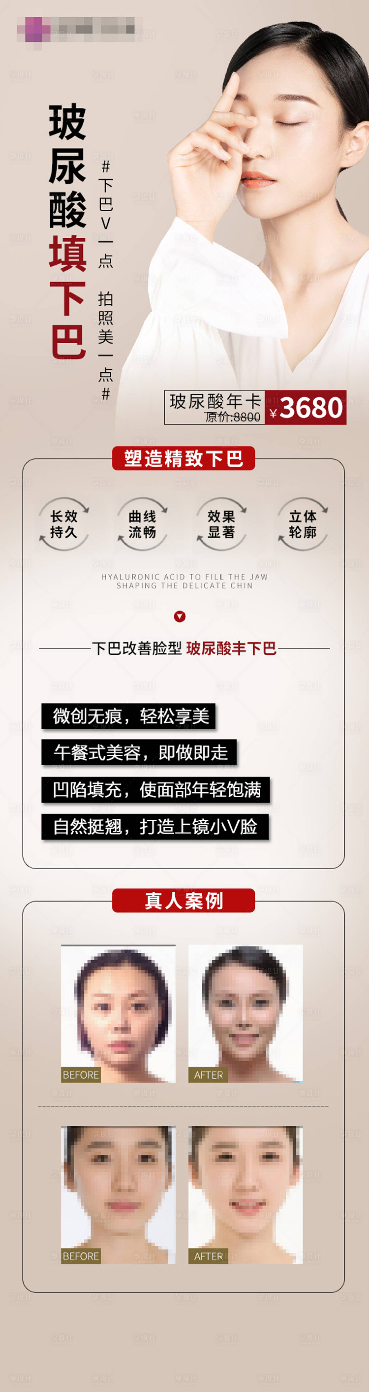 源文件下载【享设计】搜索编号：88380003338589884【医美整形玻尿酸隆鼻隆下巴长图】