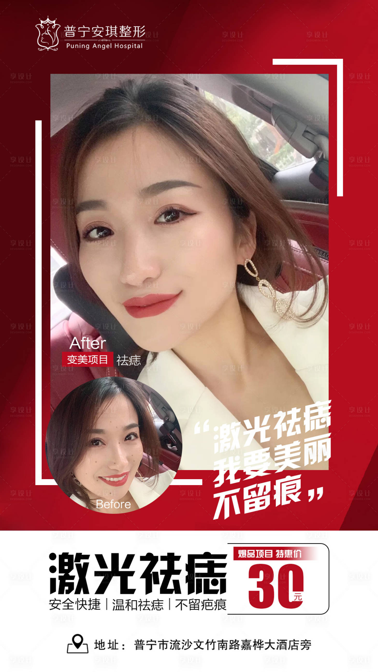 源文件下载【祛痣医美整形海报】编号：23560003192904297