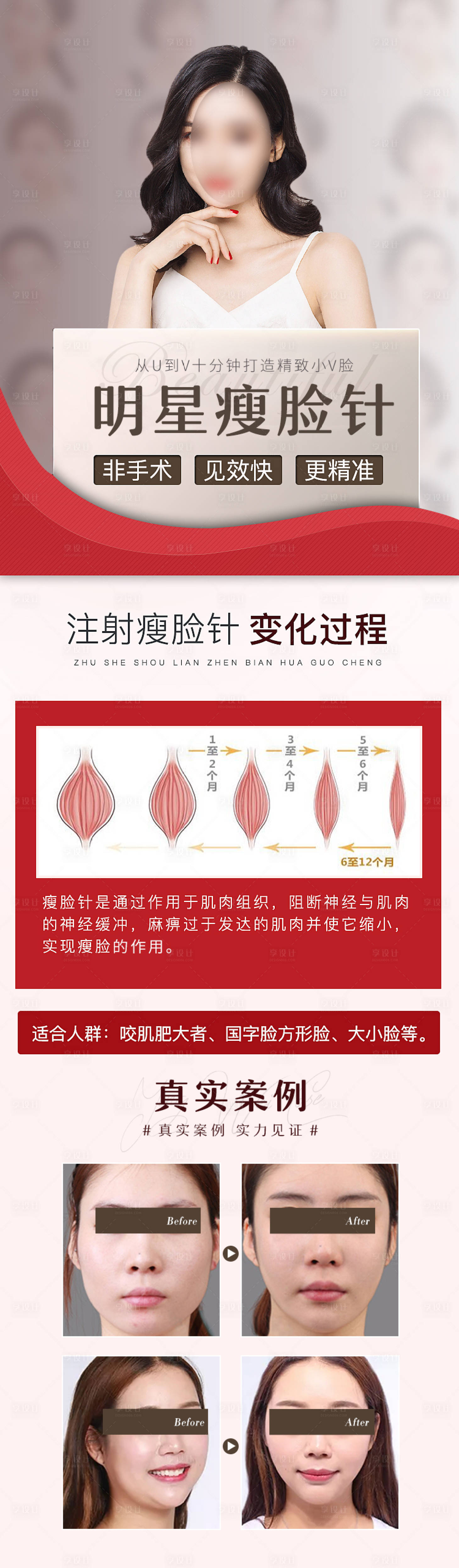 源文件下载【医美整形美容瘦脸针案例对比长图海报】编号：78970003292114043