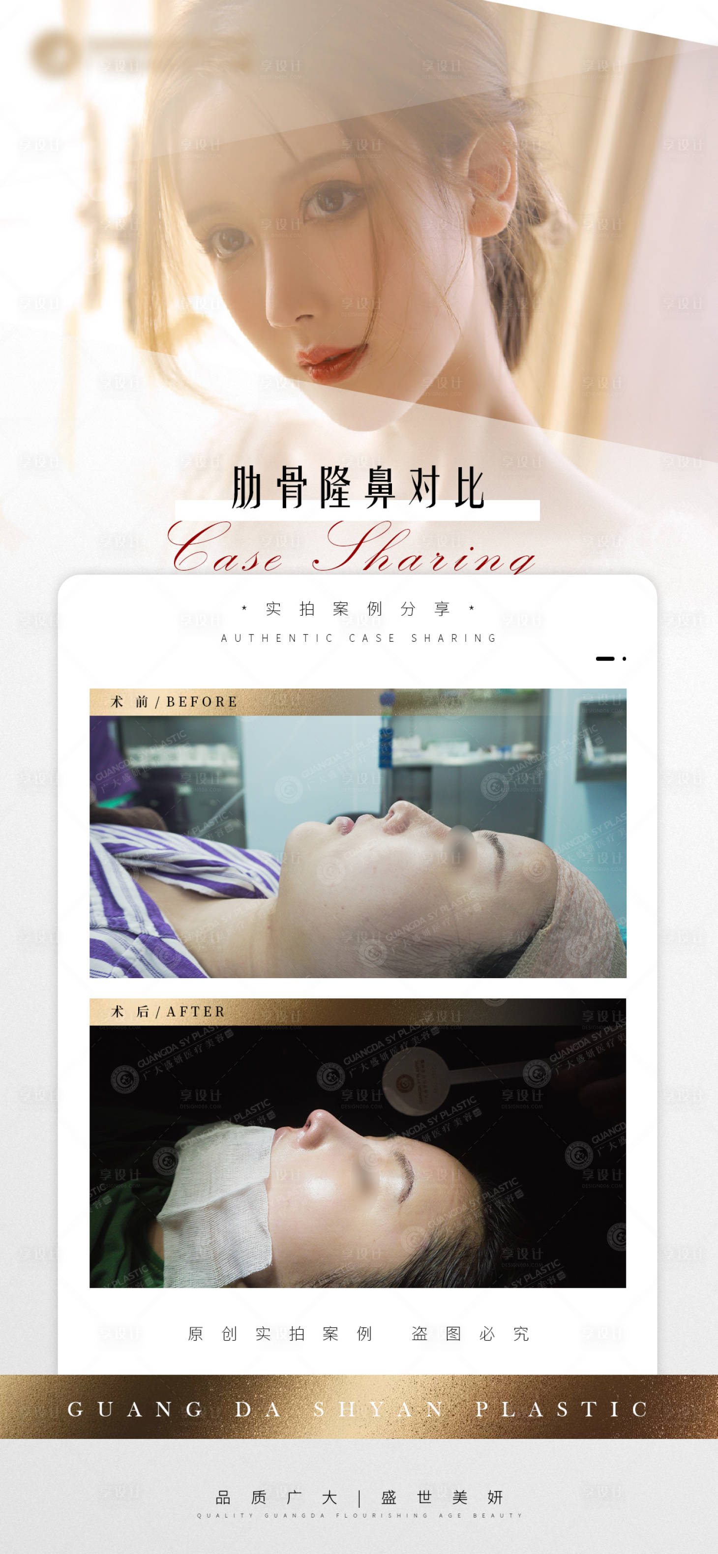 源文件下載【享設計】搜索編號：77850004899162032【醫美隆鼻案例對比圖】