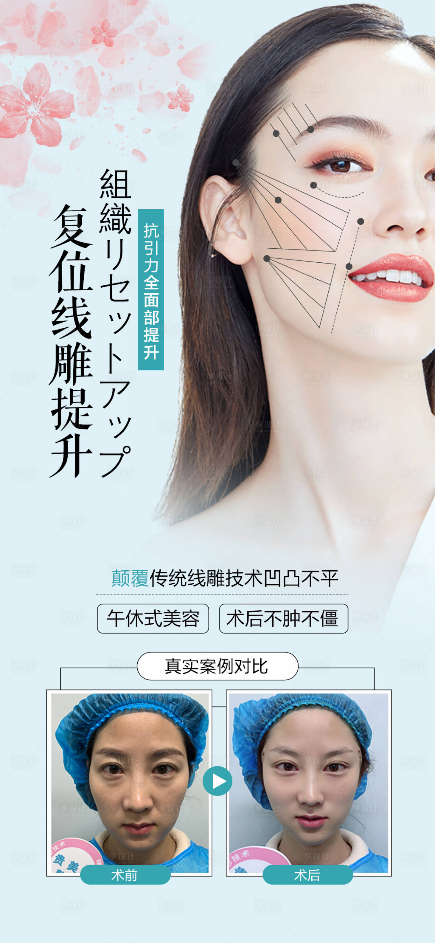 源文件下載【醫美整形線雕提升海報】編號：31080005198367972