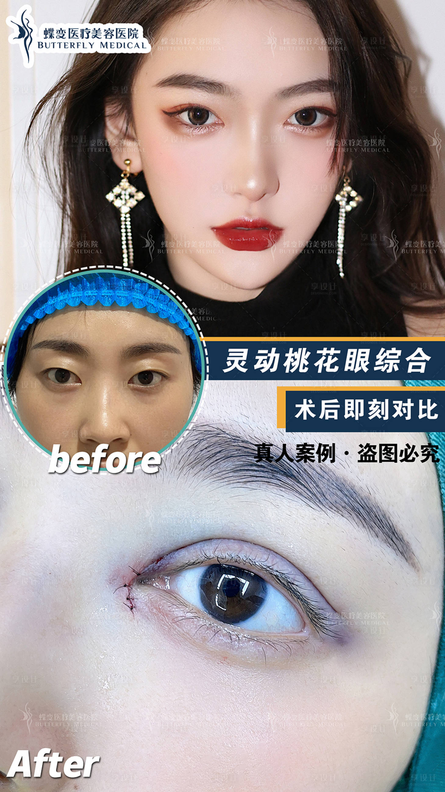 源文件下载【享设计】搜索编号：15620005548204896【医美眼综合案例对比图海报】