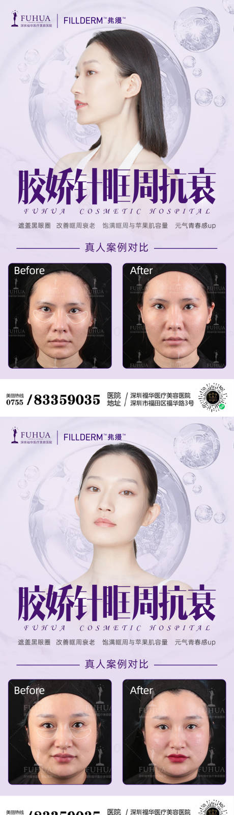 源文件下载【胶娇针眶周抗衰案例对比】编号：76400005700561201