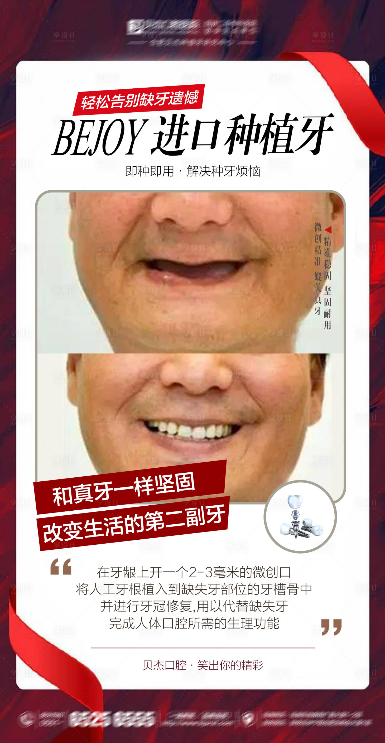 源文件下載【享設(shè)計】搜索編號：98250005832096659【口腔種植牙案例海報】