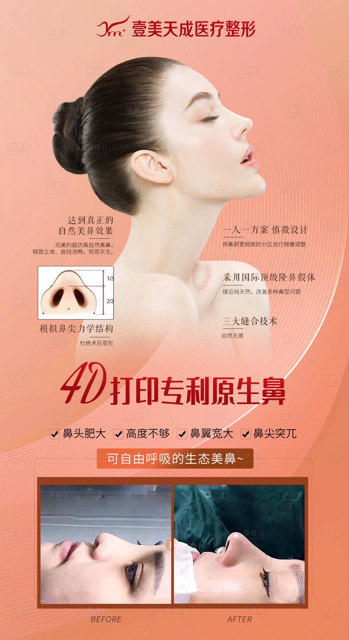 源文件下载【医美隆鼻海报】编号：44020005513021410