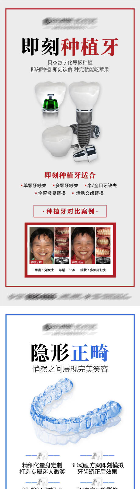 源文件下载【口腔种植牙科普案例对比海报】编号：20210730115342225
