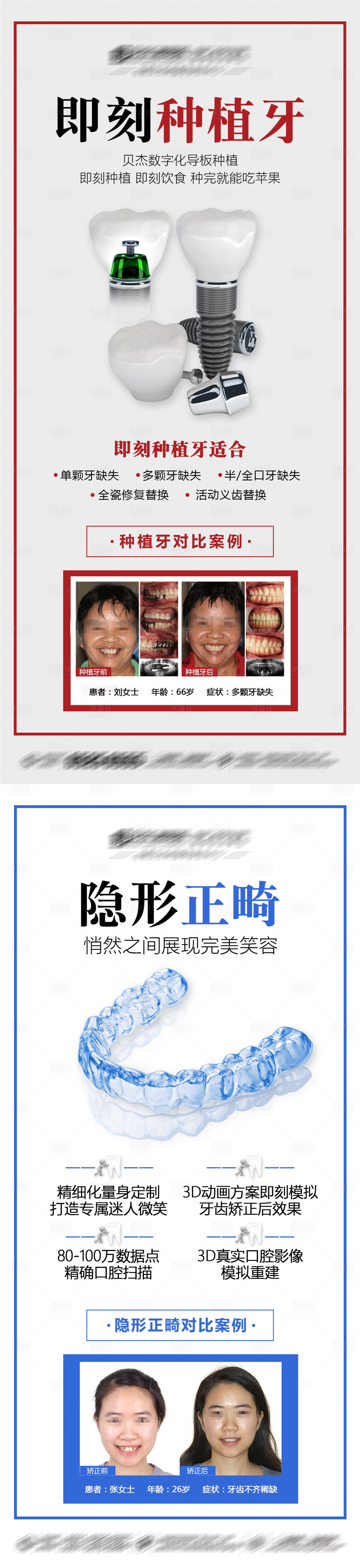 源文件下载【享设计】搜索编号：76680005820301075【口腔种植牙科普案例对比海报】