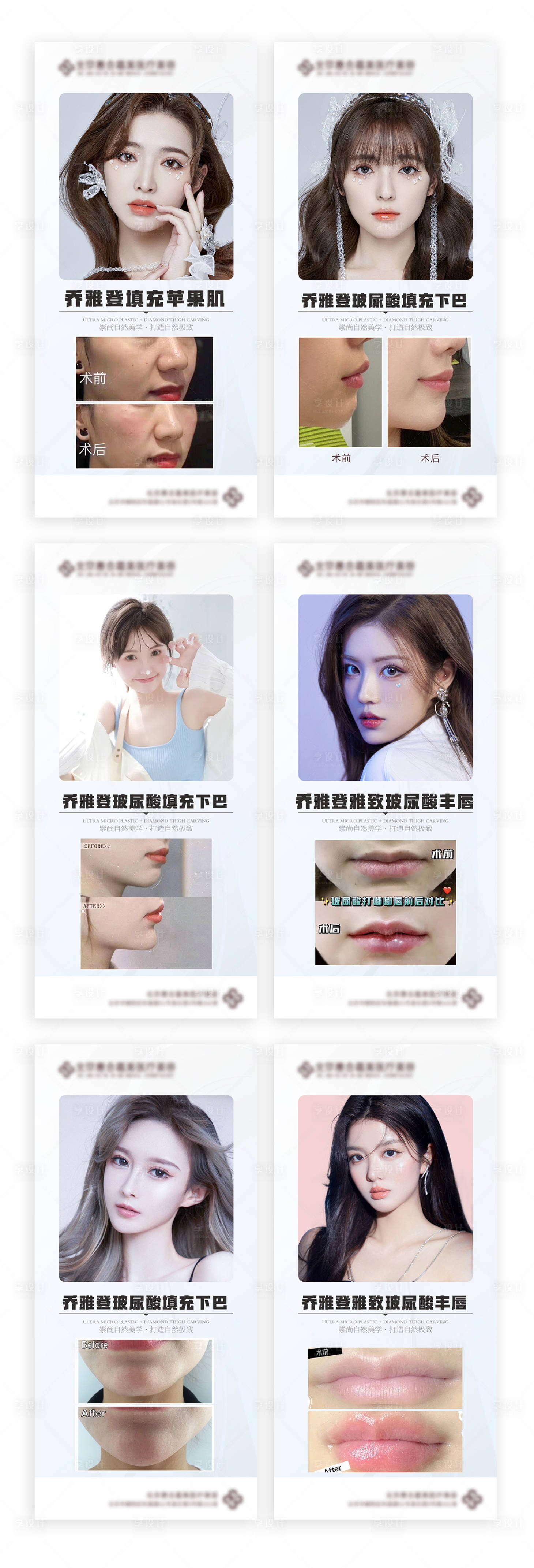 源文件下载【医美玻尿酸填充案例对比海报】编号：94440006476007813