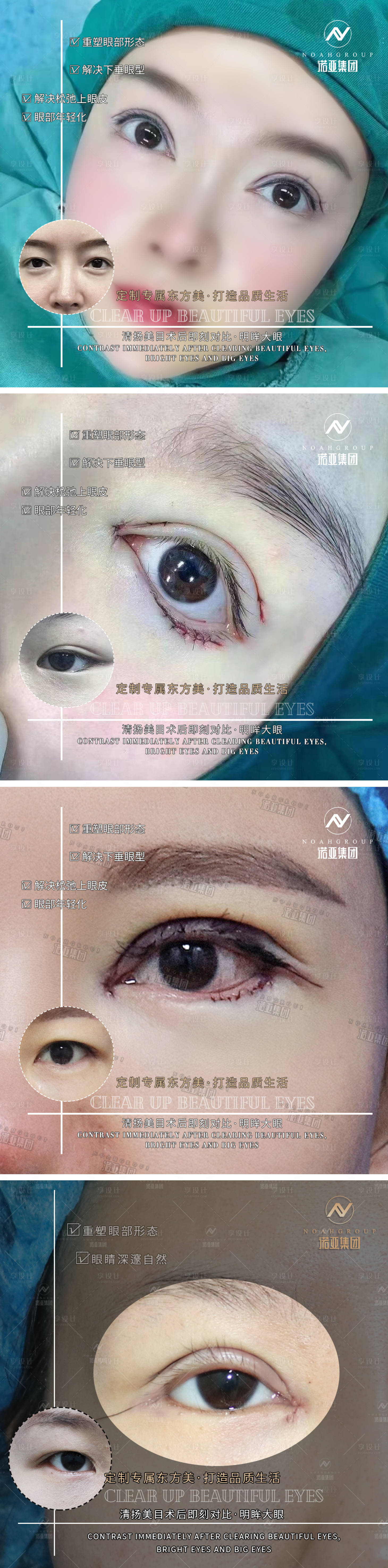 源文件下载【享设计】搜索编号：78660006461542816【医美整形案例对比海报】