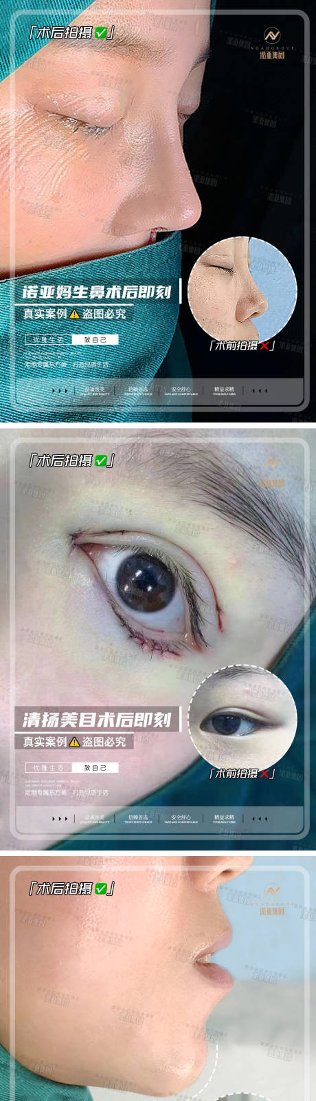 源文件下载【享设计】搜索编号：57770006720539957【医美整形案例对比海报】