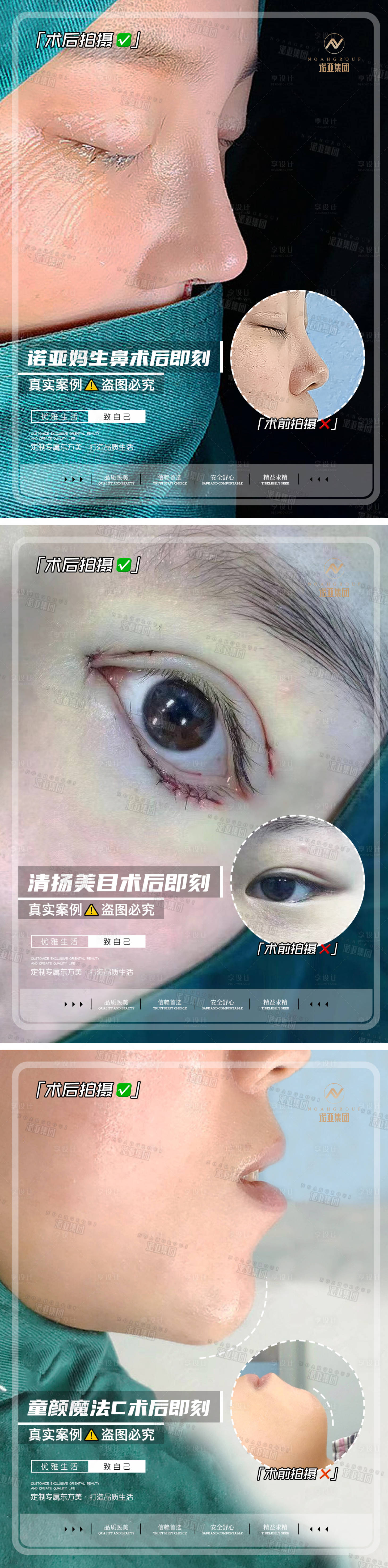 源文件下载【享设计】搜索编号：57770006720539957【医美整形案例对比海报】