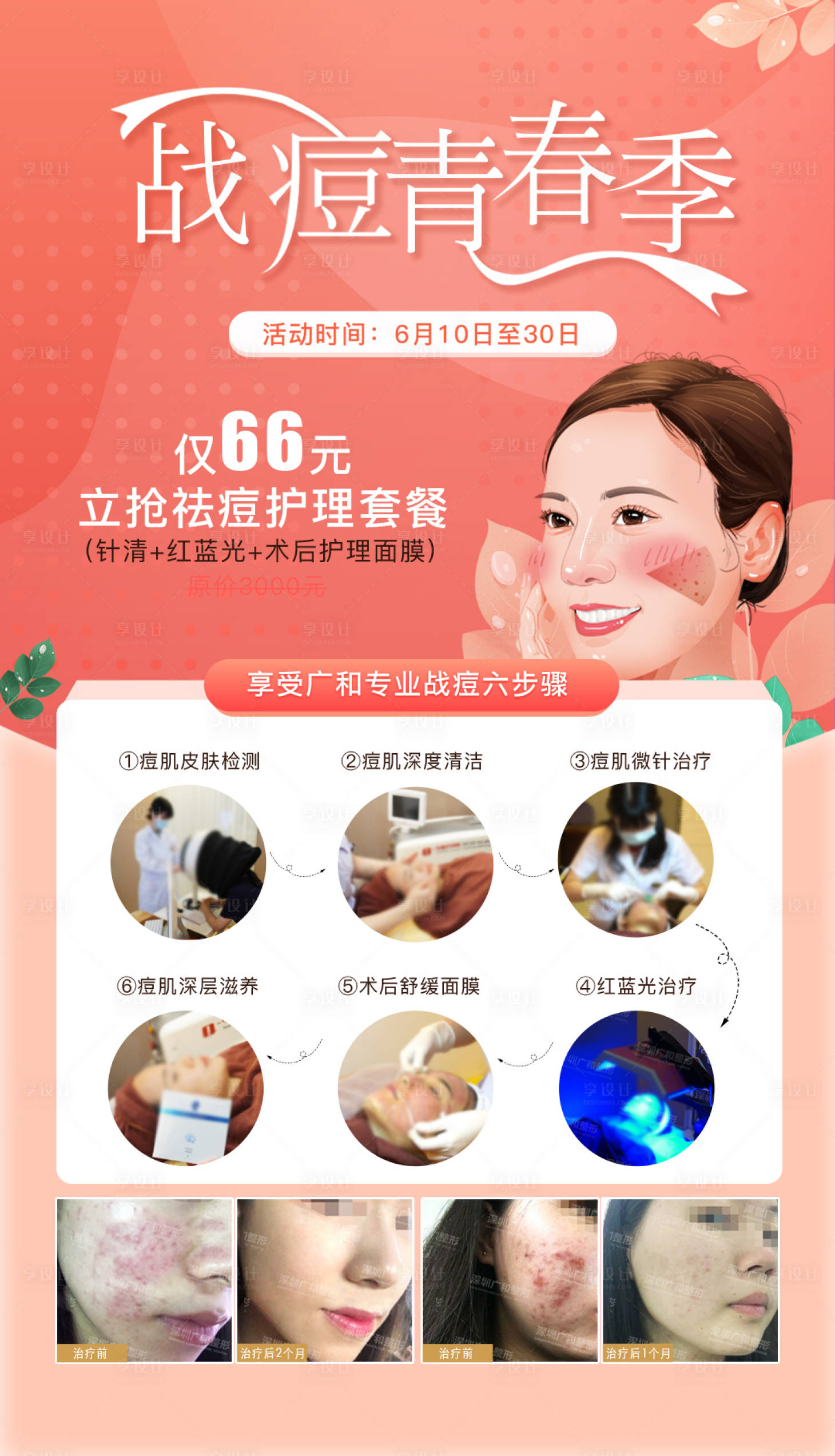 源文件下载【医美祛痘流程活动海报】编号：36650007185481707