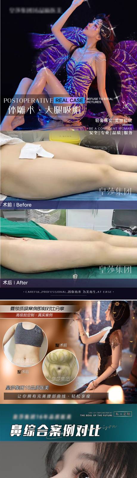 源文件下載【享設計】搜索編號：77030007301663000【醫美案例大腿環吸海報】