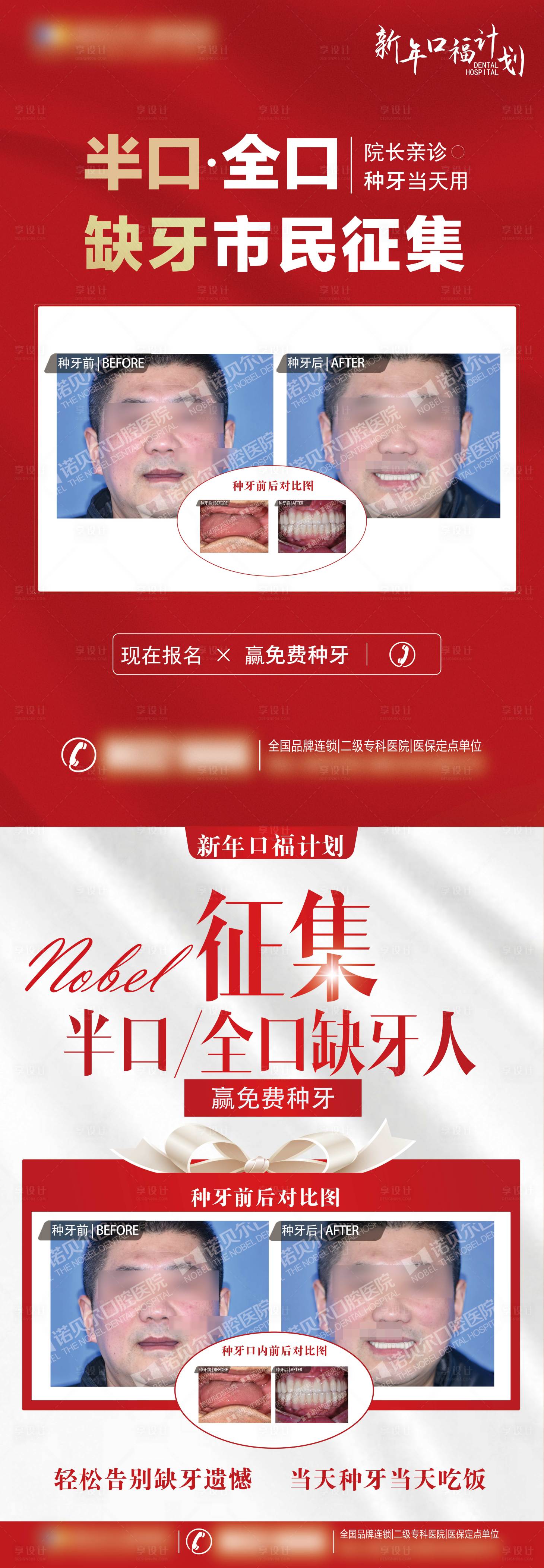 源文件下载【缺牙半口全口种植牙展架】编号：42090007255248516