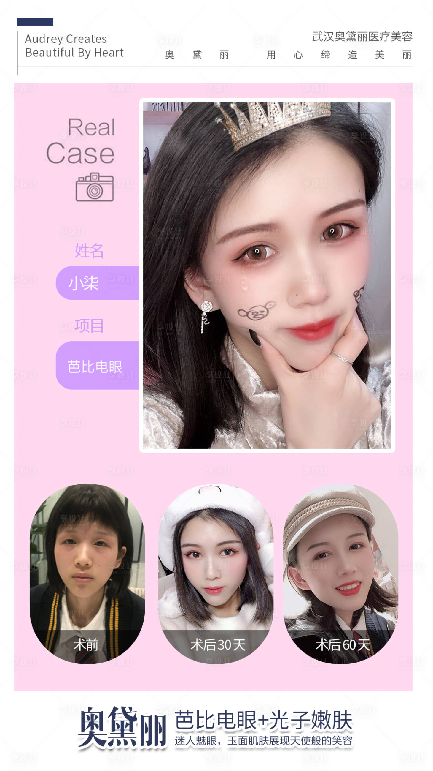 源文件下载【医美双眼皮案例对比海报】编号：96390007759531681