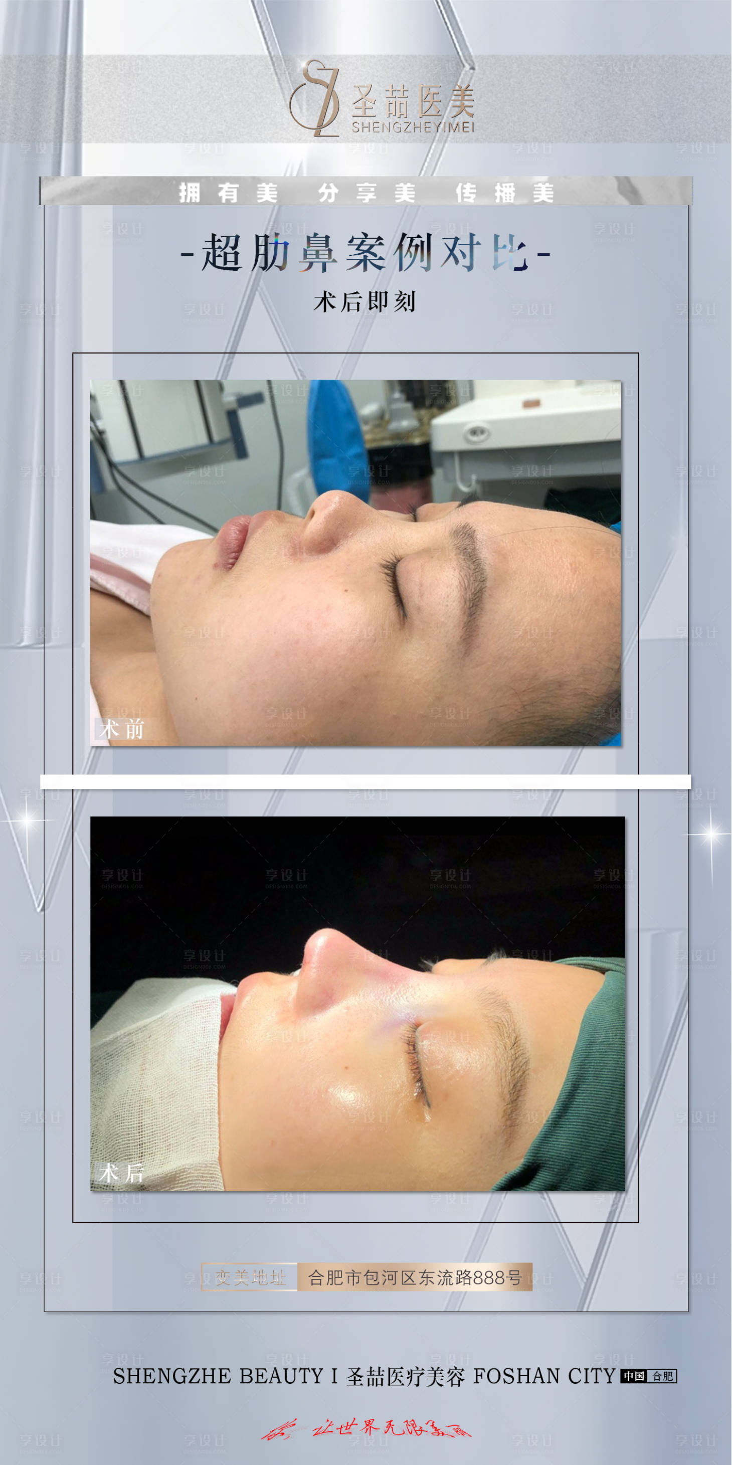 源文件下载【享设计】搜索编号：74040007477022076【医美整形案例简约海报】