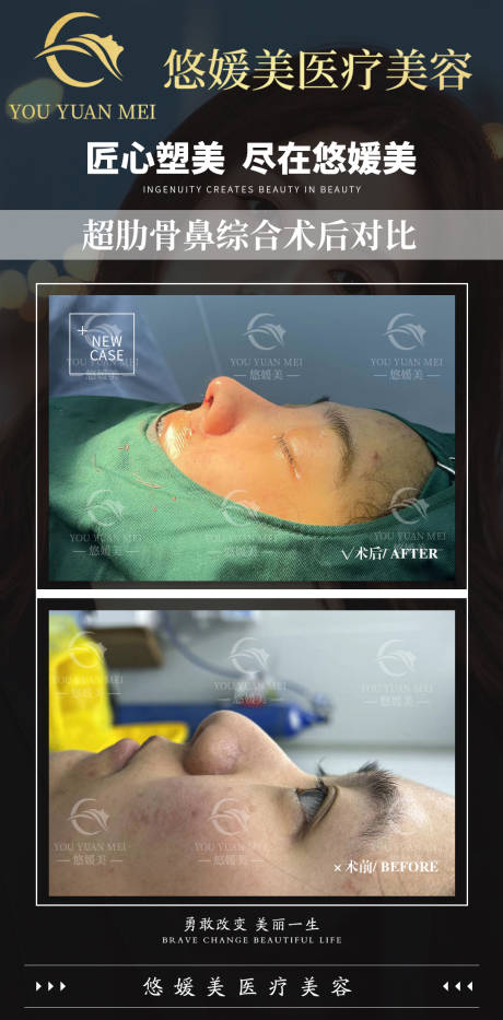 源文件下载【医美肋骨鼻综合海报】编号：44040008073261328