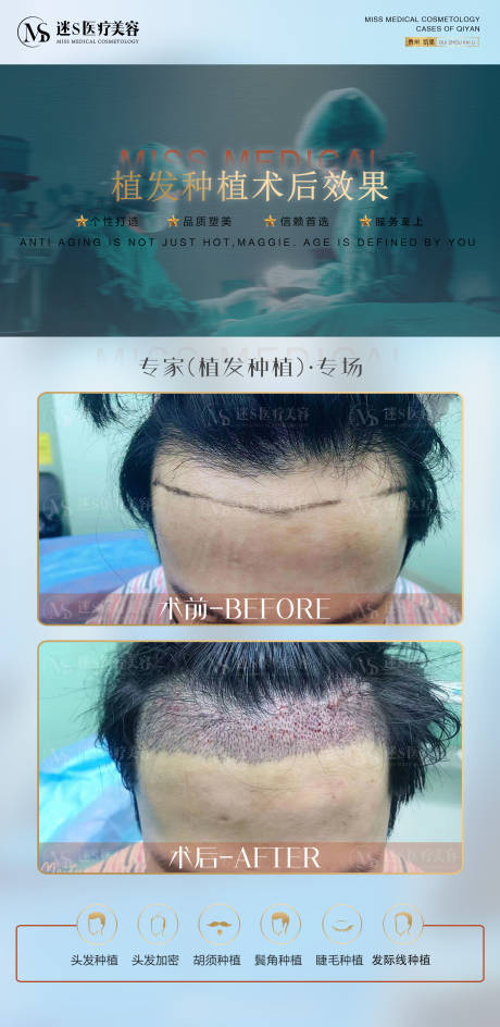 源文件下載【享設計】搜索編號：48430008119002253【植發案例對比海報】