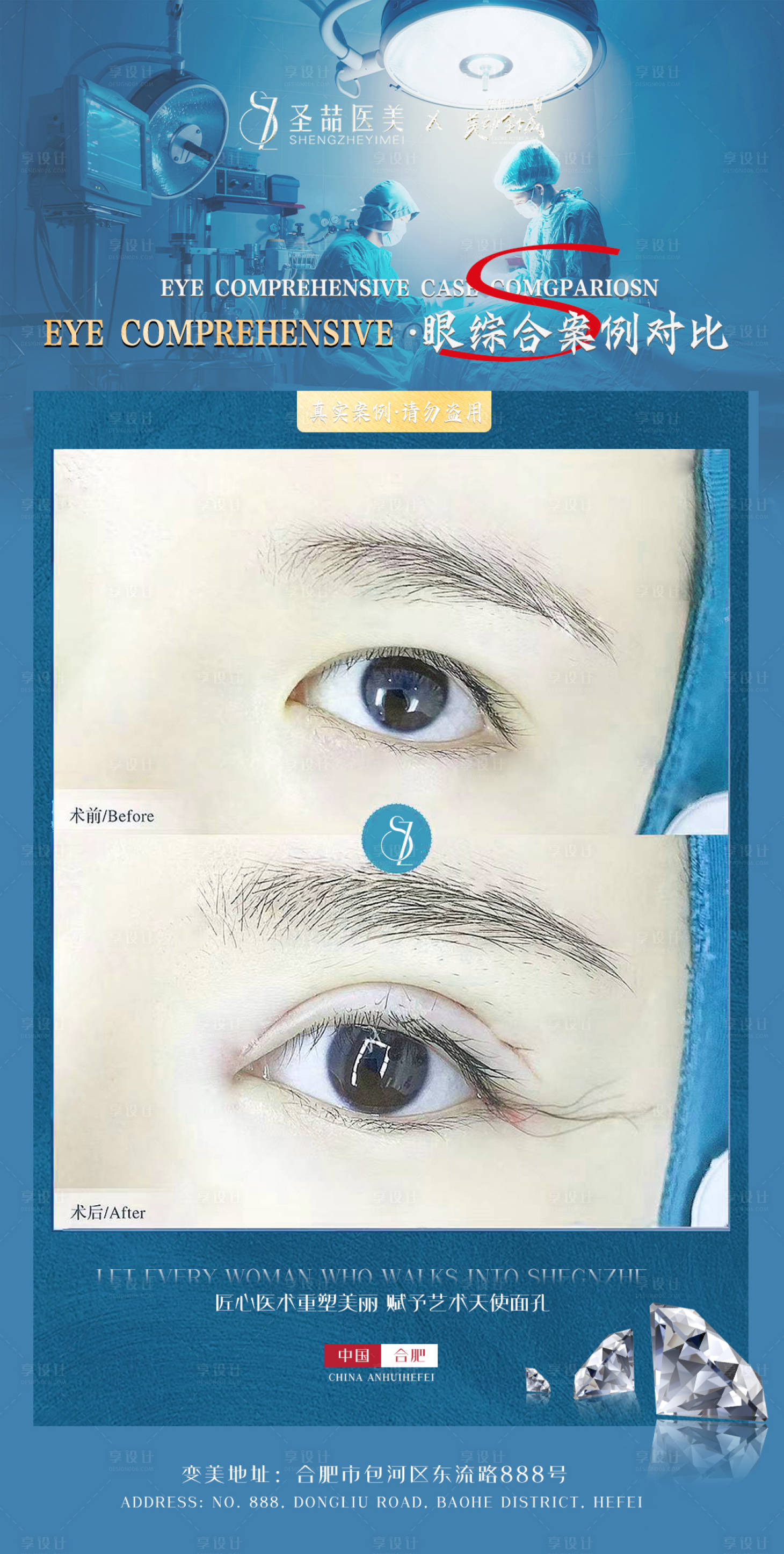 源文件下載【享設(shè)計(jì)】搜索編號(hào)：61040008038562120【醫(yī)美整形案例海報(bào)】