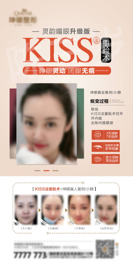 源文件下载【kiss法重睑术】编号：20220218151544882