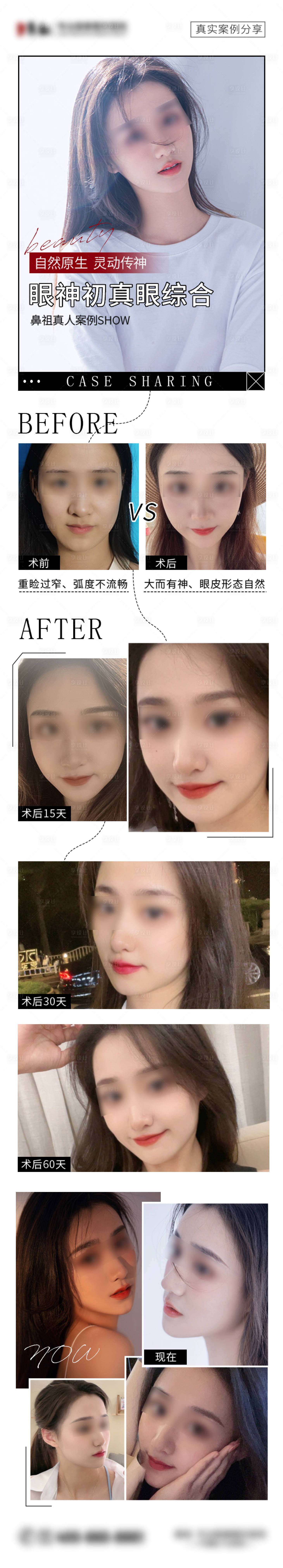 源文件下載【享設計】搜索編號：27990008531276630【醫美雙眼皮對比長圖海報】
