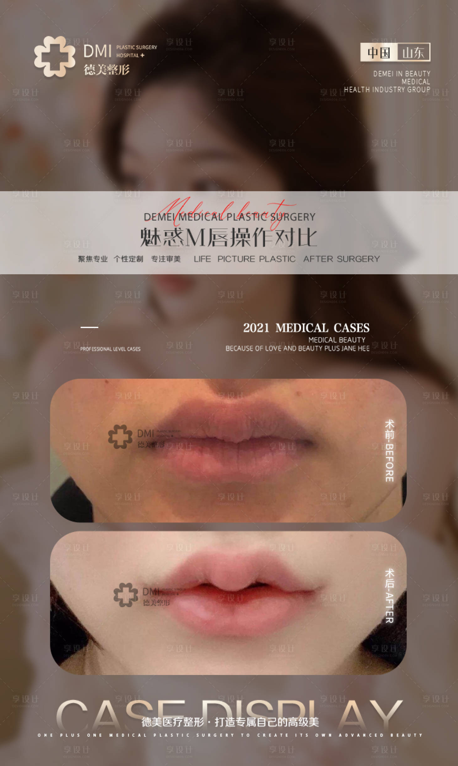 源文件下载【医美对比案例海报】编号：56280008651469662