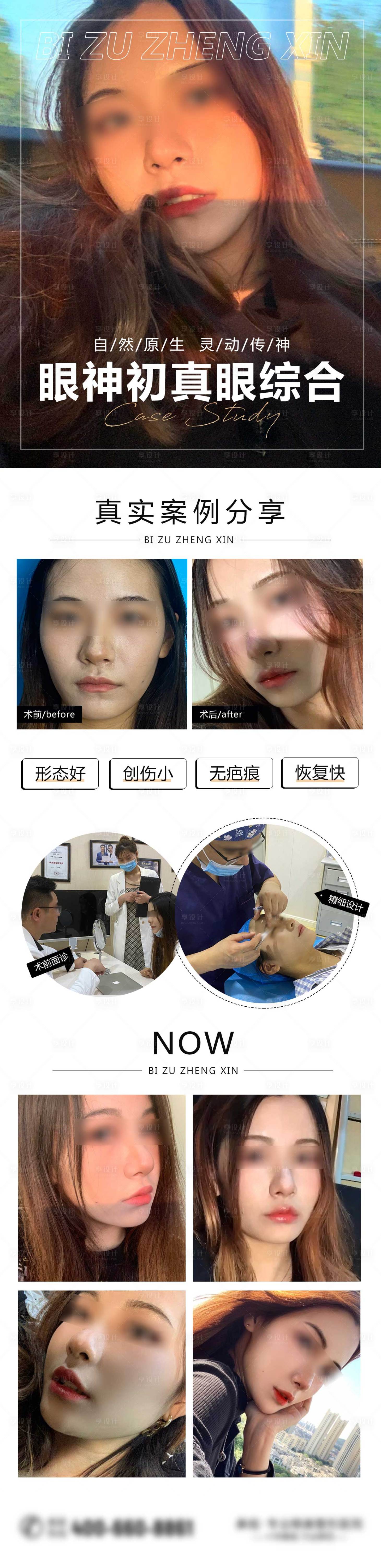 源文件下载【医美双眼皮案例对比图】编号：78780008595643562