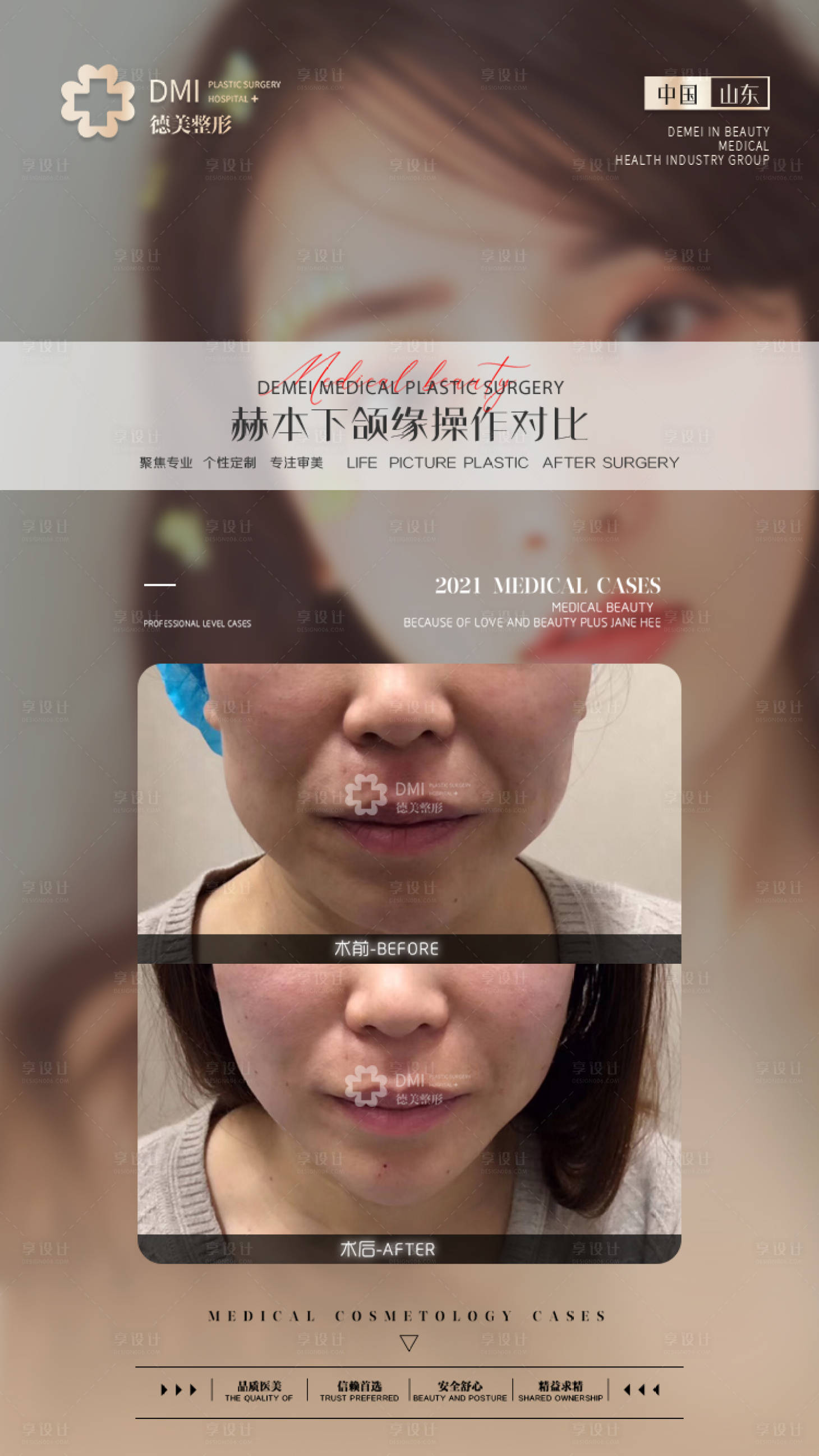 源文件下载【医美对比图下颌】编号：76180008651292069