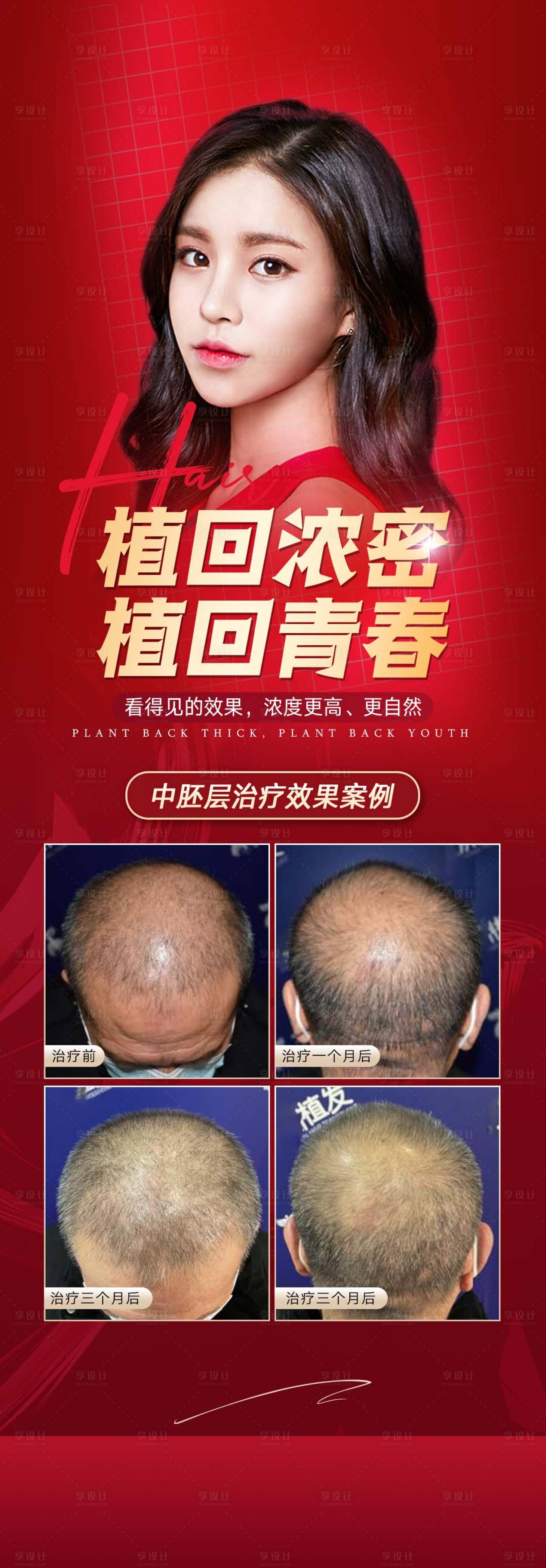 源文件下載【享設計】搜索編號：68080008944659229【植發(fā)活動醫(yī)美長圖海報】