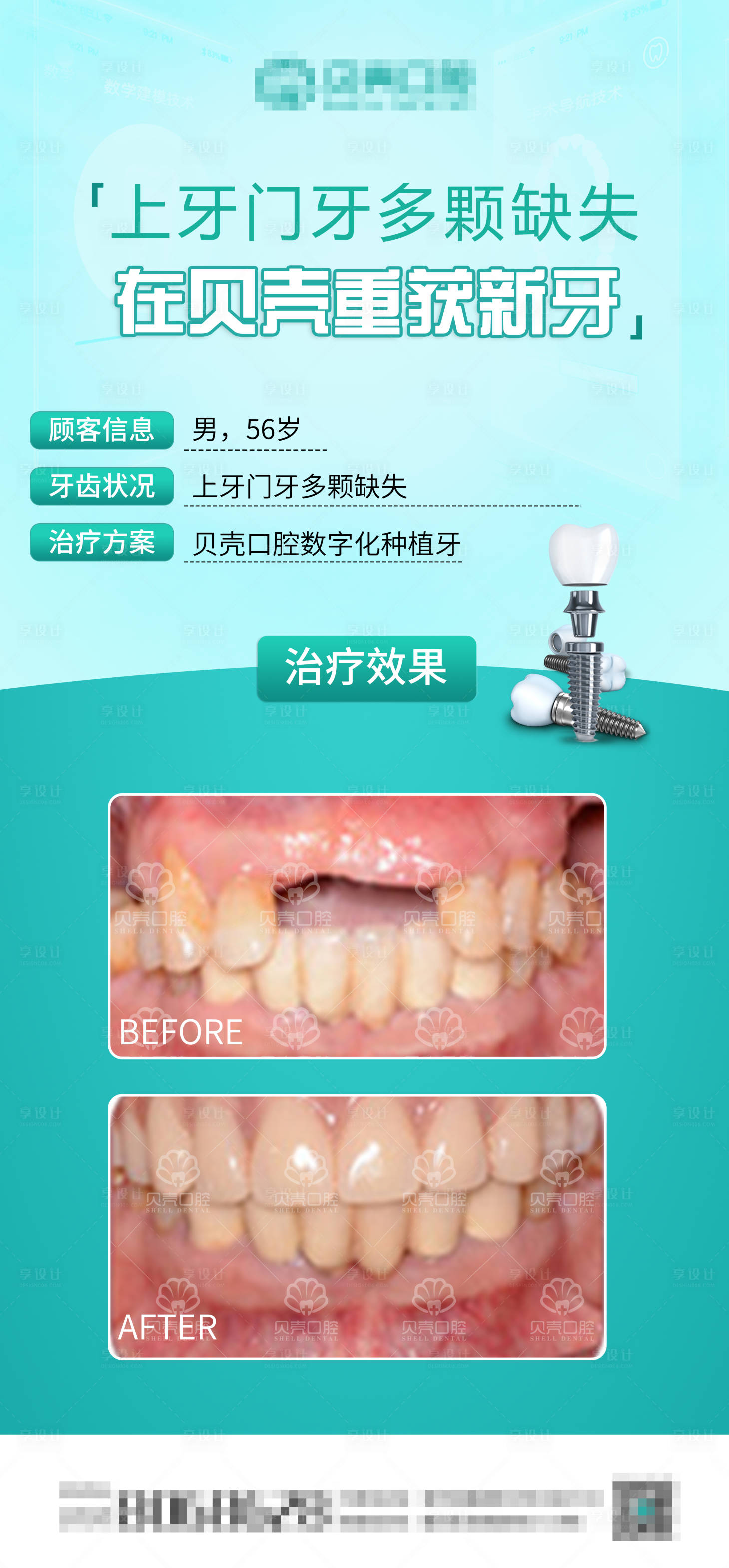 源文件下载【享设计】搜索编号：63050009158049060【种植牙案例分享海报】