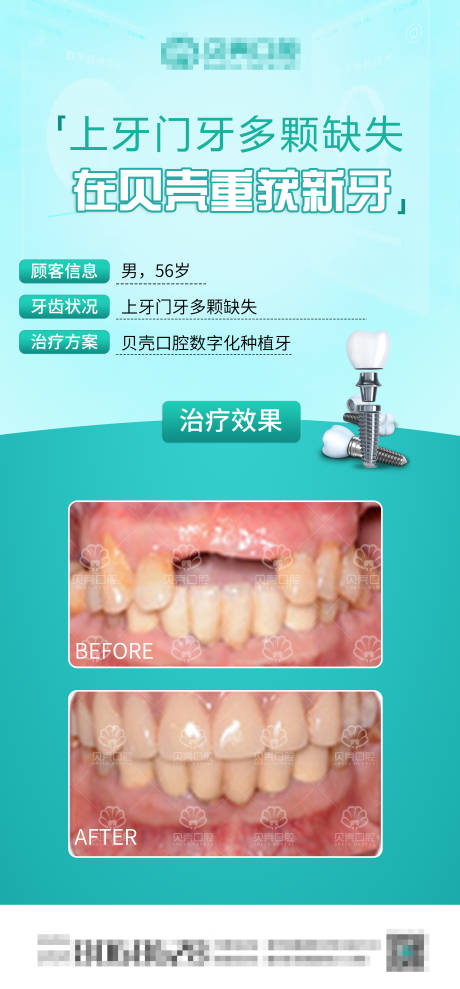源文件下载【种植牙案例分享海报】编号：20220328164651329