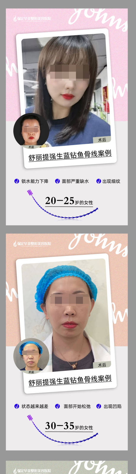 源文件下载【舒立提强生蓝钻鱼骨线】编号：20220305133759294