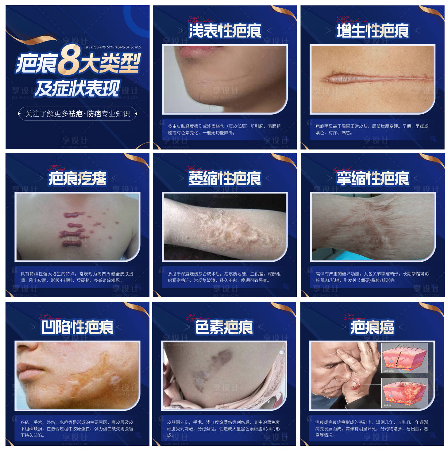 源文件下載【享設(shè)計】搜索編號：73780009045392684【醫(yī)療疤痕的8大類型九宮格】