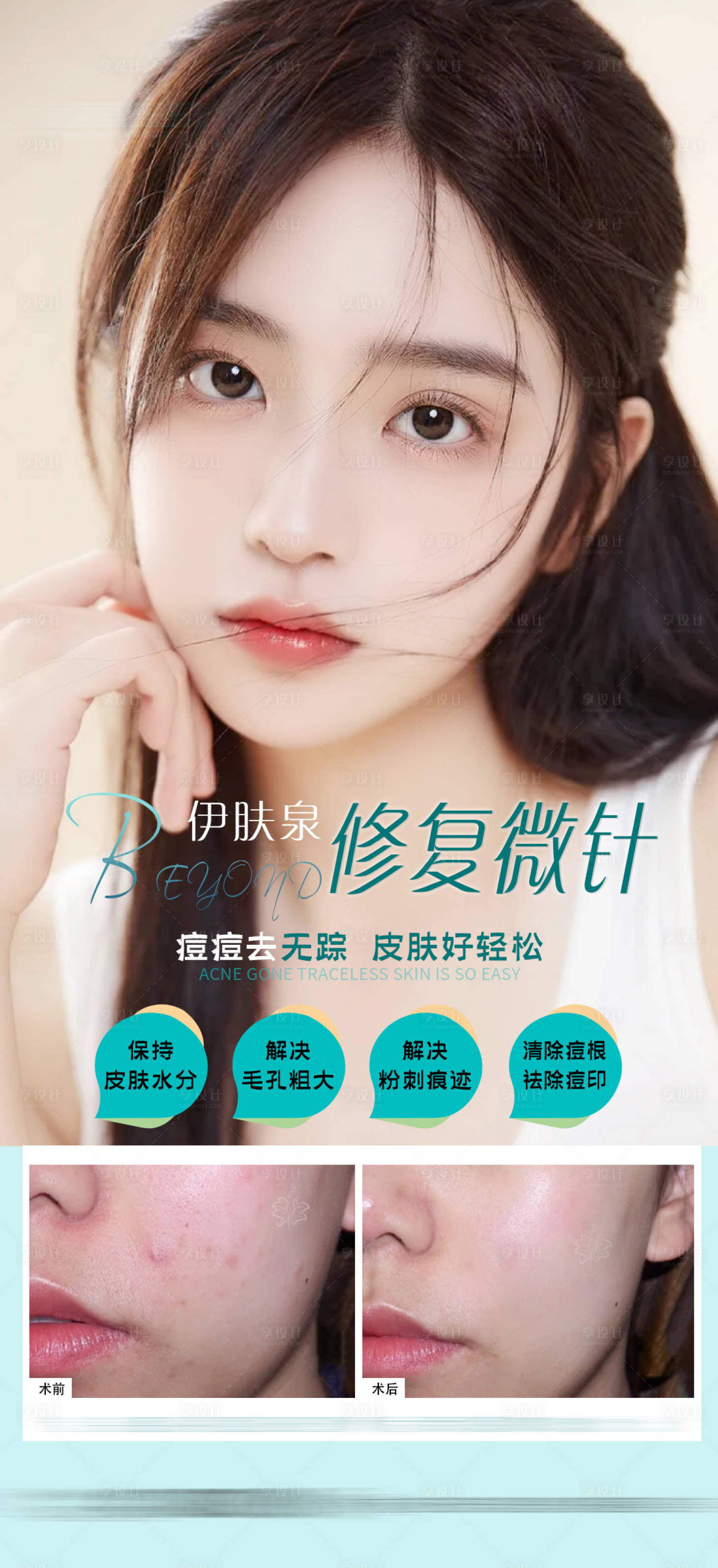 源文件下载【医美祛痘案例海报】编号：84270009103999831