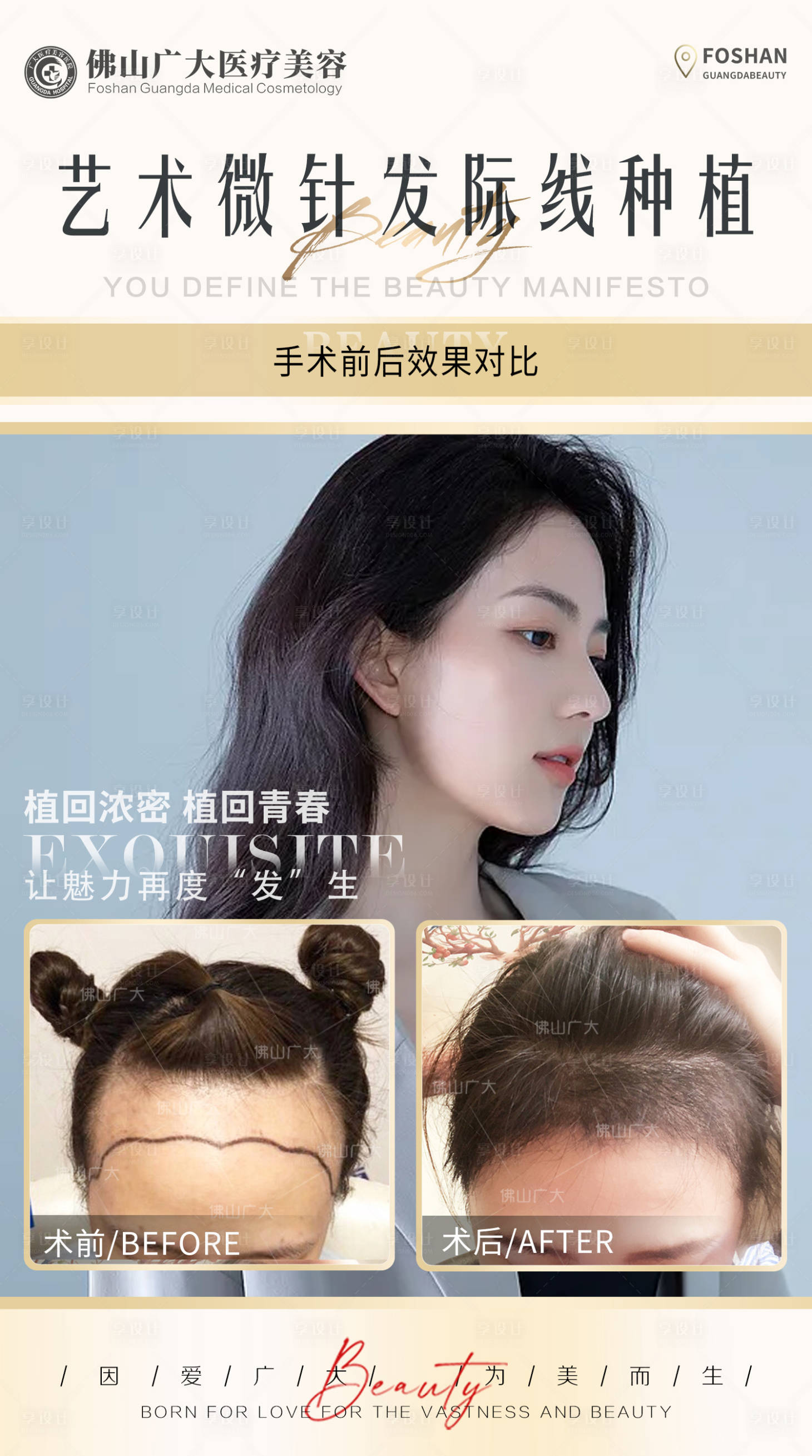 源文件下载【享设计】搜索编号：85470008816625583【艺术微针发际线种植】