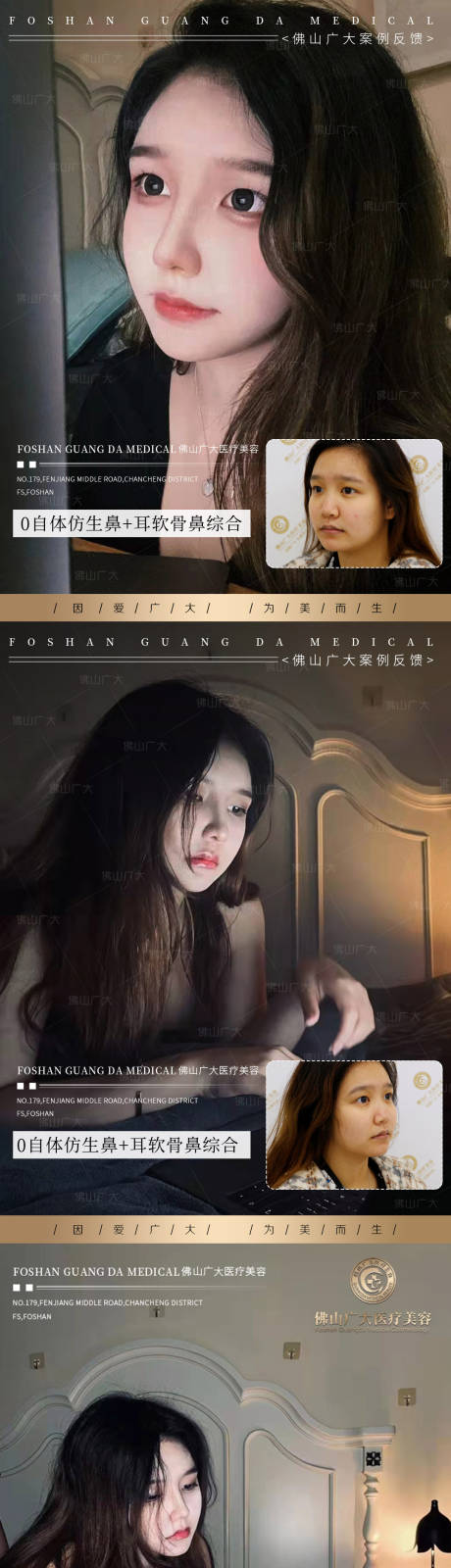 源文件下载【医美整形真人案例分享海报】编号：64310009617697940