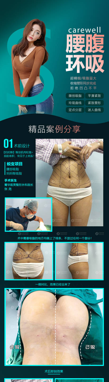源文件下载【腰腹环吸电商详情页】编号：98340009256634497