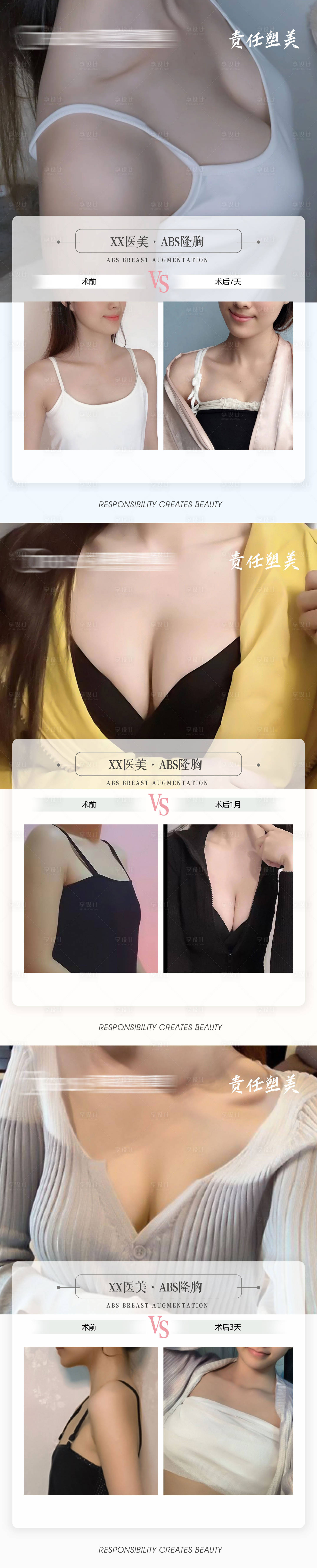 源文件下載【享設(shè)計(jì)】搜索編號(hào)：84330009661017599【醫(yī)美豐胸案例對(duì)比】