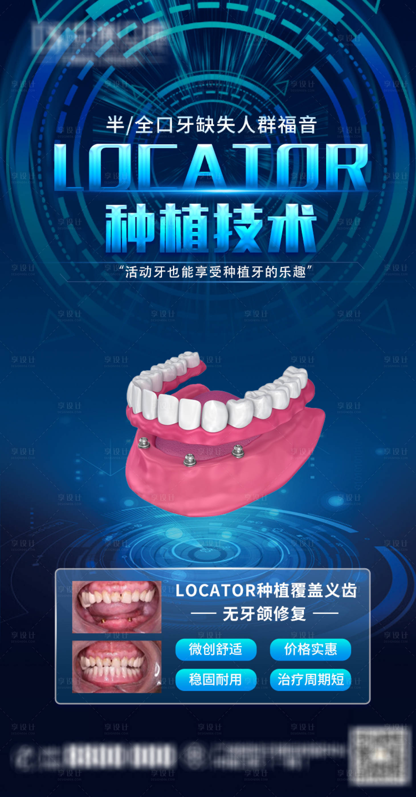 源文件下载【Locator口腔种植活动义齿】编号：76830009533808048