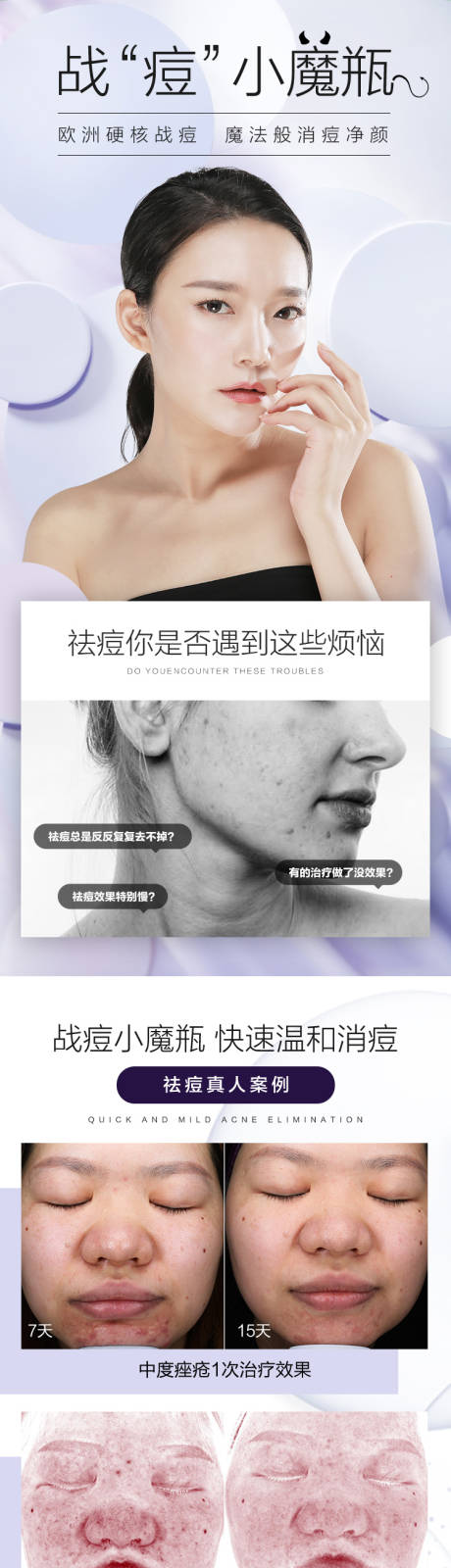 源文件下载【战痘小魔瓶详情页】编号：48910009740129904