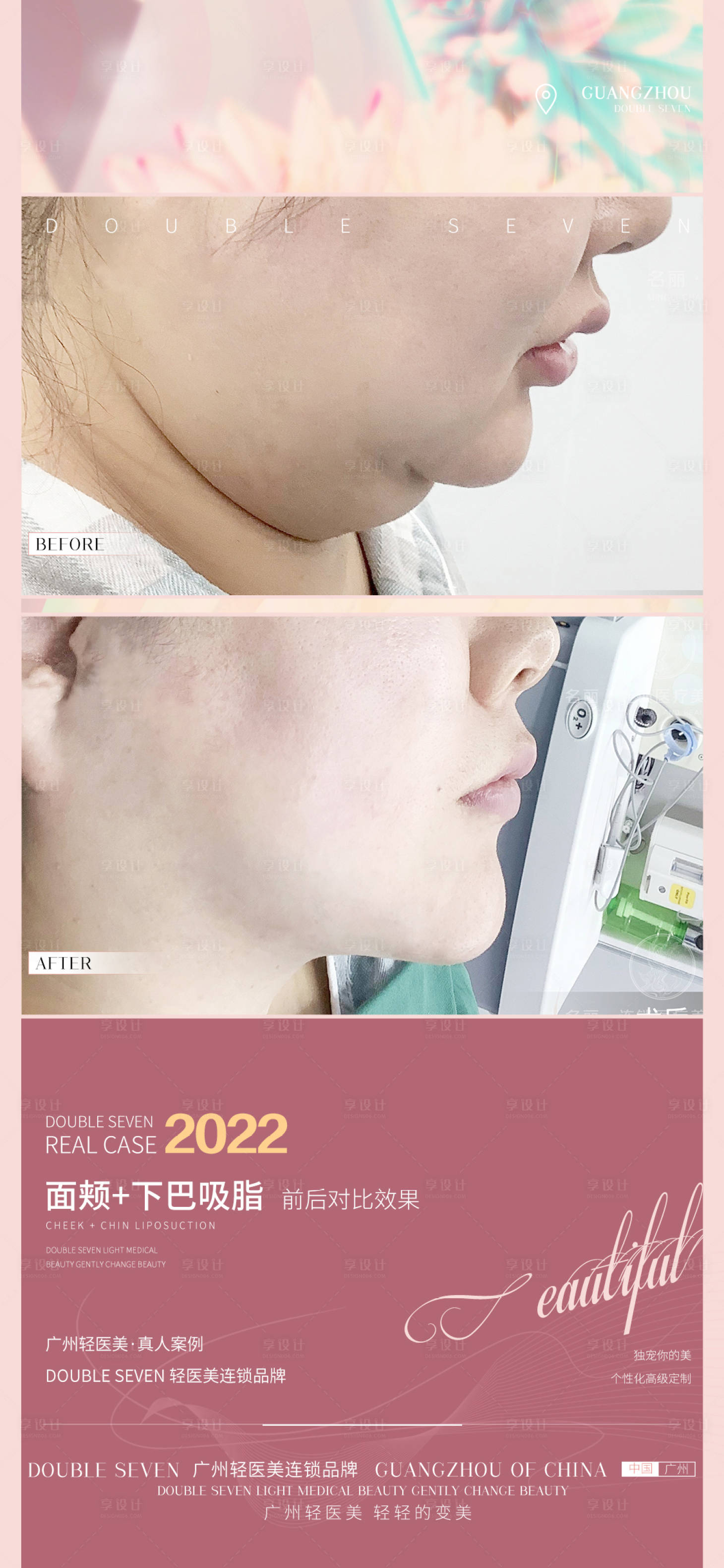 源文件下载【享设计】搜索编号：82020010266488831【医美案例海报】