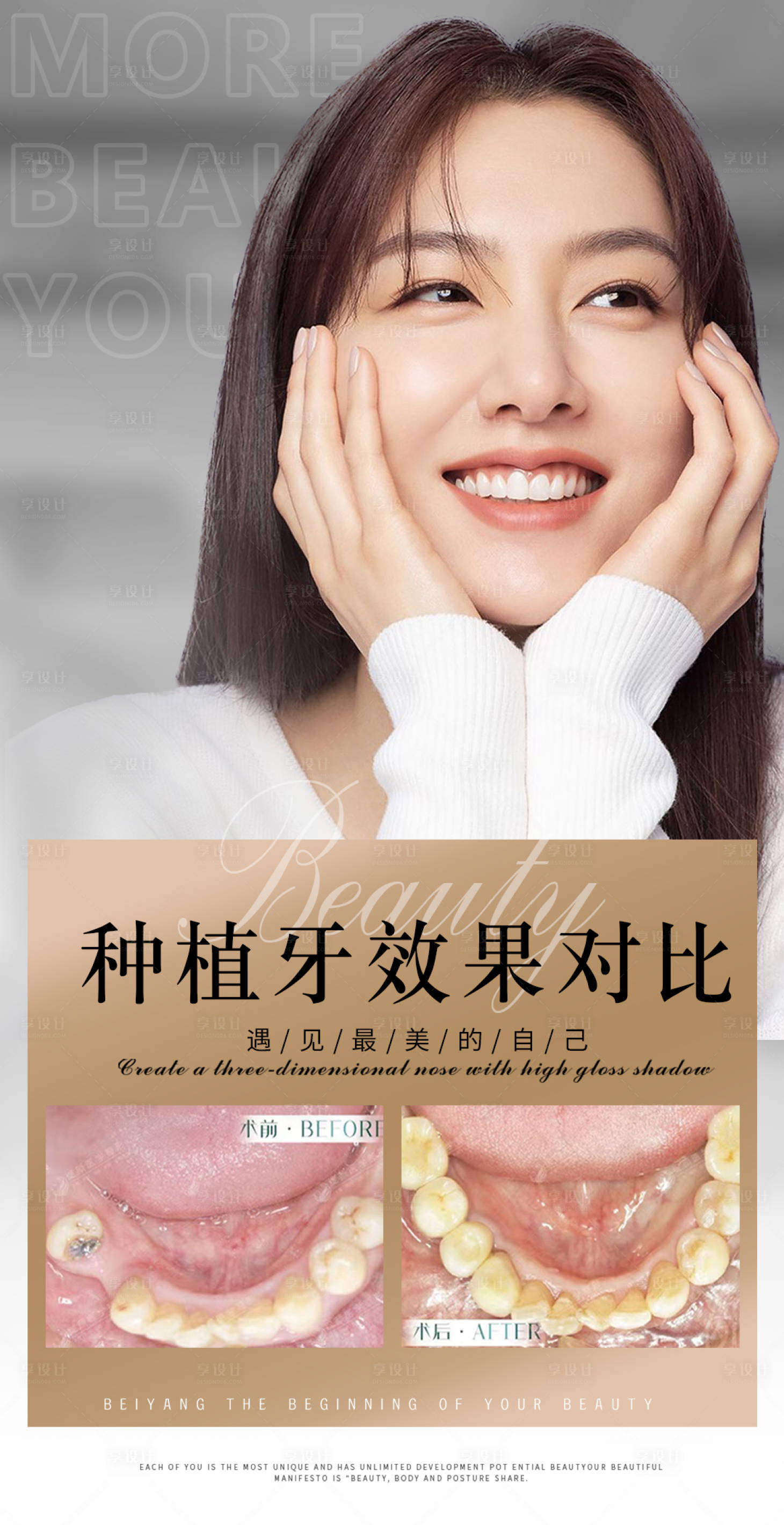 源文件下載【享設計】搜索編號：41010009830648251【醫美口腔案例種植牙海報】