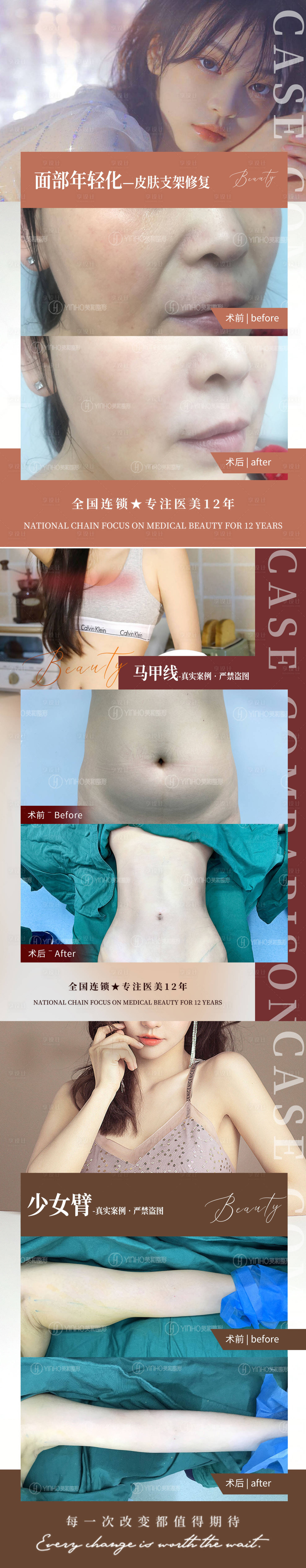 源文件下載【享設計】搜索編號：33210010790503234【醫美案例對比圖系列海報】