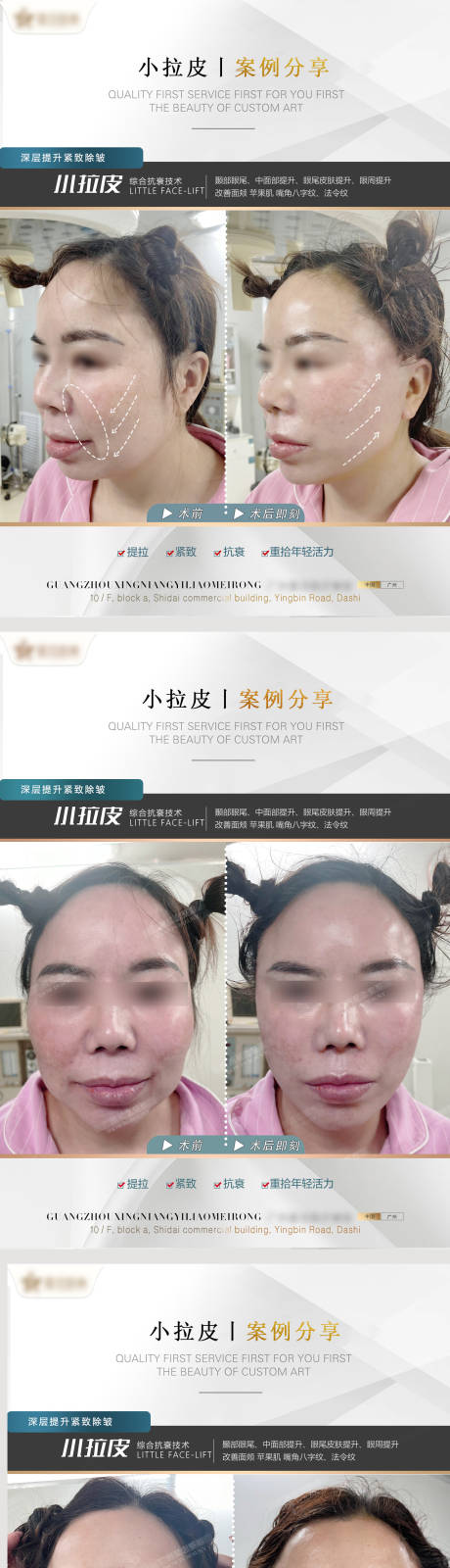 源文件下载【医美小拉皮案例系列海报】编号：71420010605004136