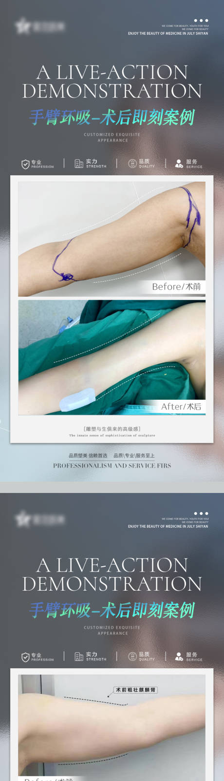 源文件下载【手臂环吸案例】编号：84940010612787620