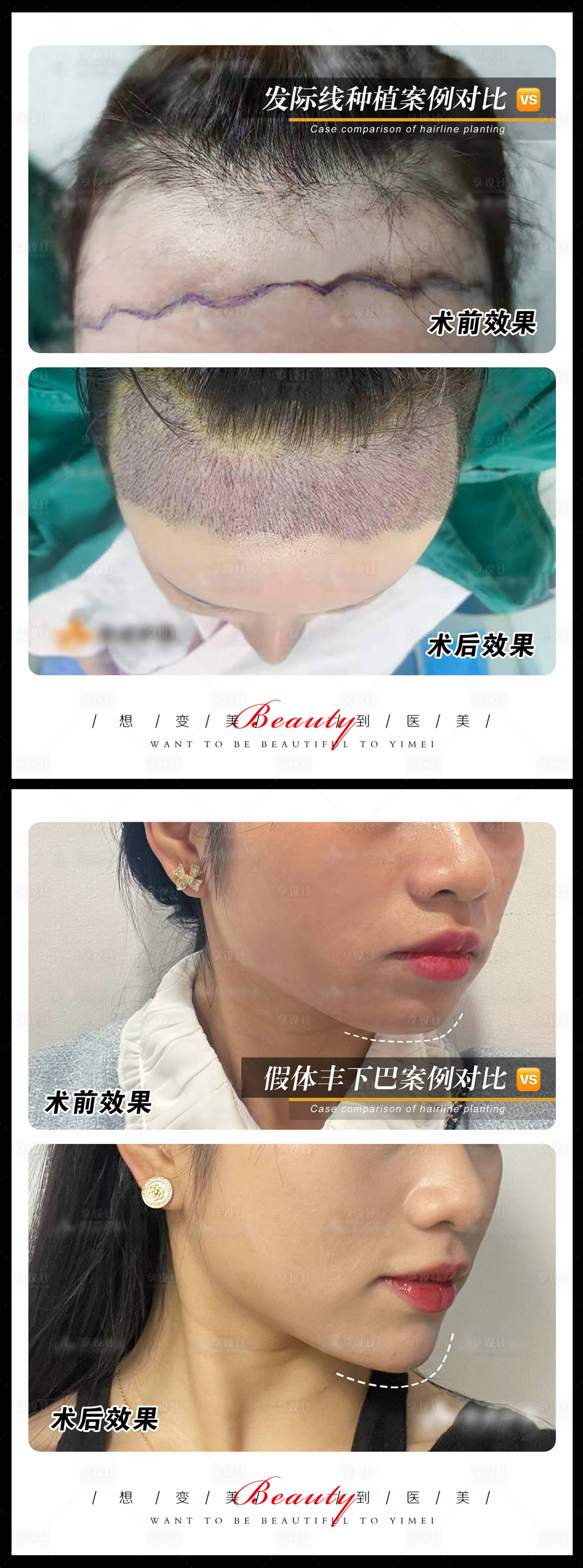 源文件下载【享设计】搜索编号：77850010902711724【医美案例模板系列海报】