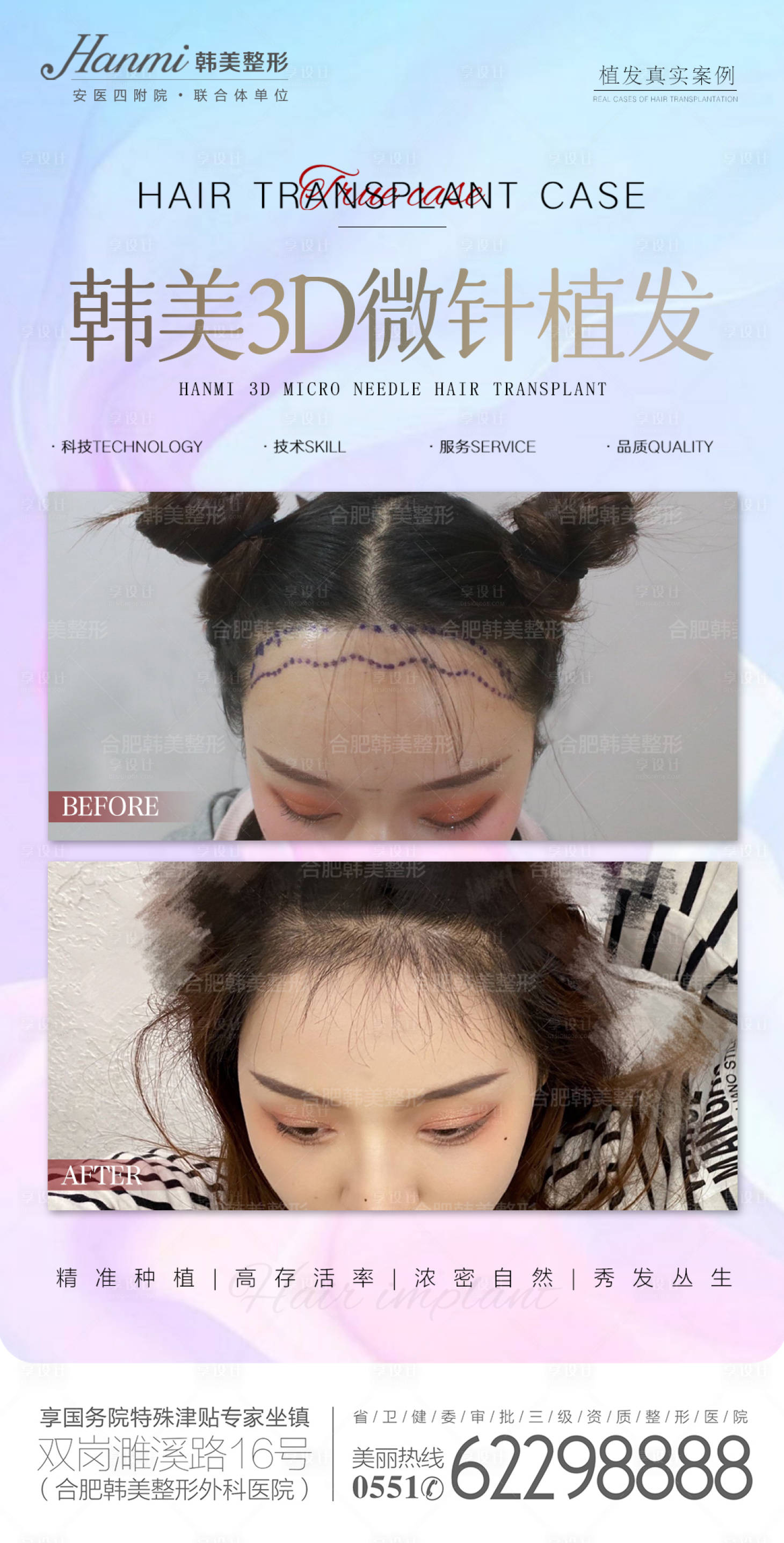 源文件下载【享设计】搜索编号：65820010872981903【医美植发海报】