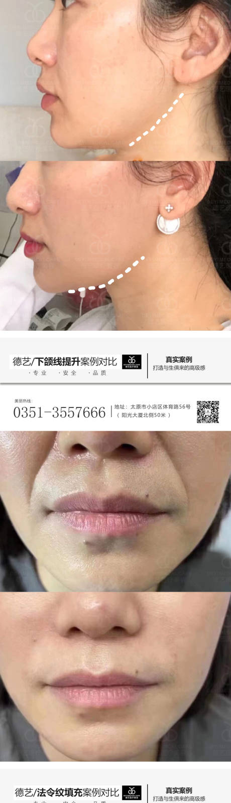 源文件下载【享设计】搜索编号：83050011224949516【医美案例对比人物系列海报】