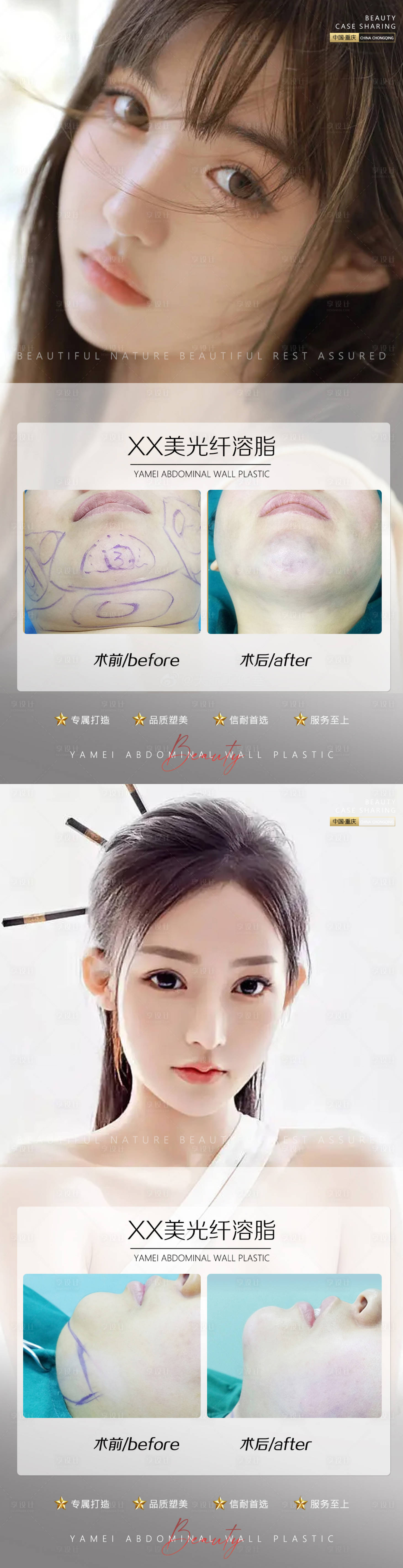 源文件下载【享设计】搜索编号：11620010851212932【医美光纤溶脂案例系列海报】